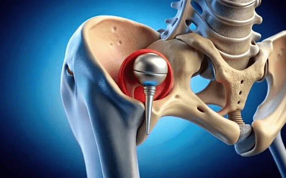 Robotic Hip Replacement