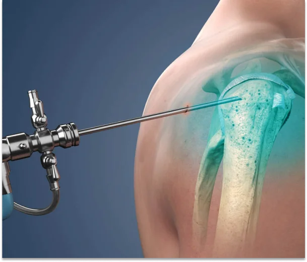 Shoulder Arthroscopy