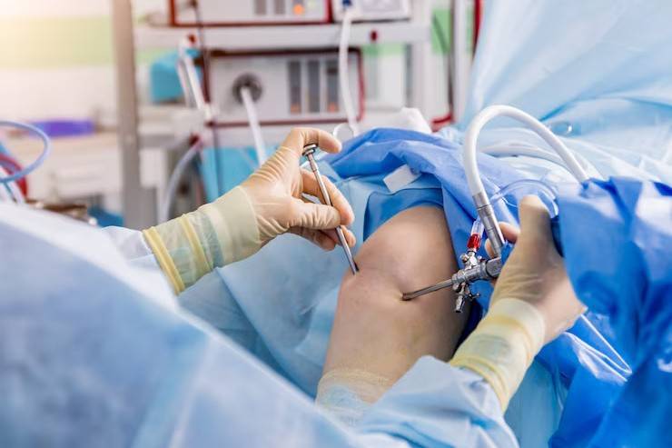 Read more about Knee Arthroscopy